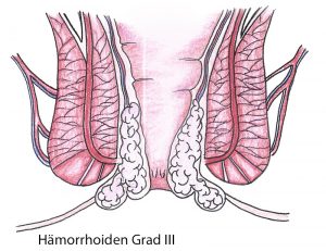 haemorrhoiden_grad_iii